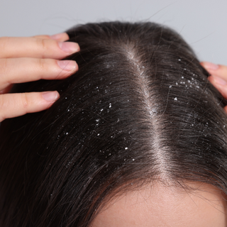 Dandruff
